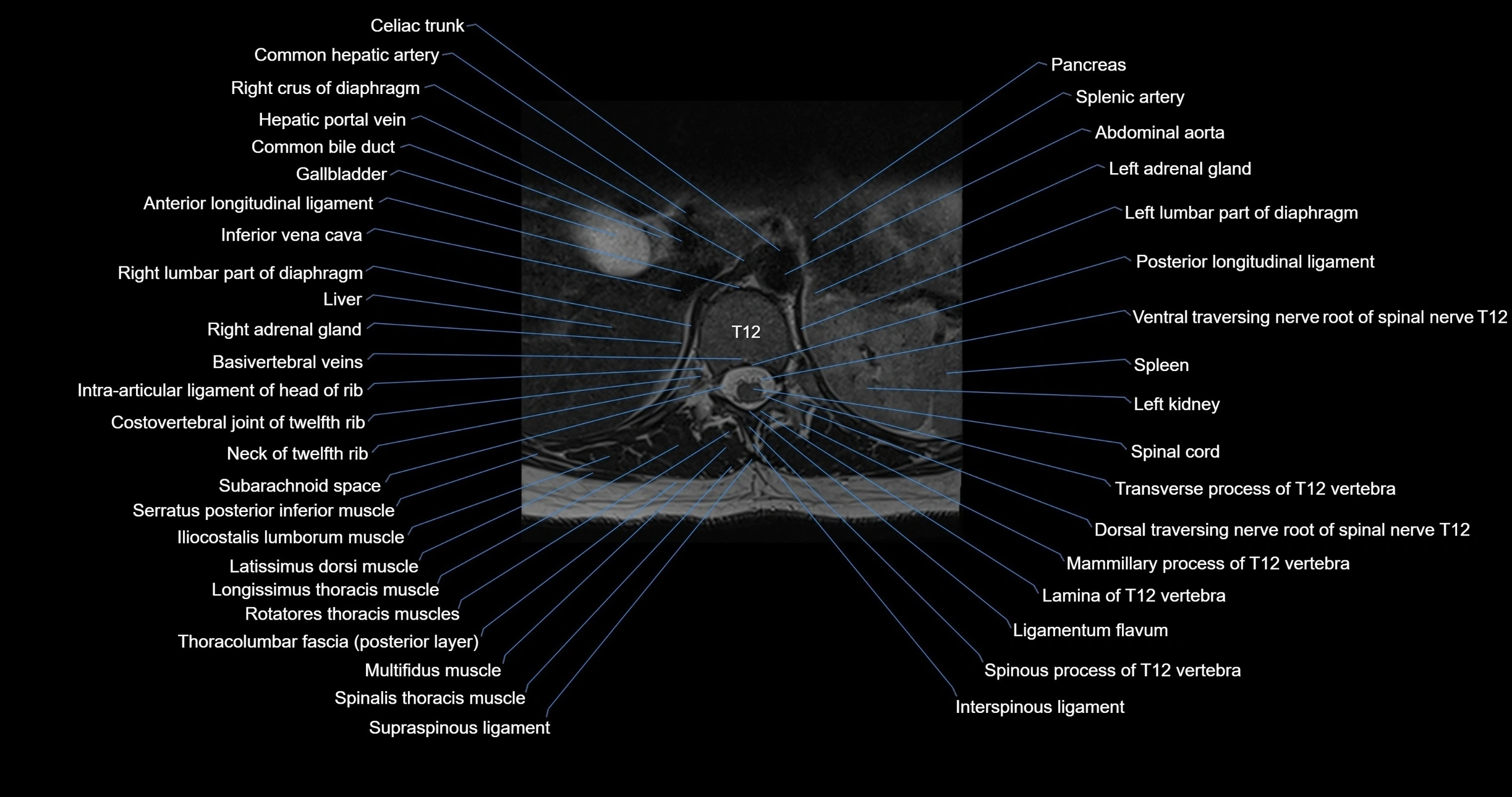 MRI lumbar spine axial cross sectional anatomy 3T radiology  image-img-00001-00002.webp